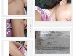 Diduga Tindak Pidana Penganiayaan Terhadap Mardiah, ketua LP Nasdem provinsi Riau Bapak Barita Ritonga Meminta Kepada Bapak Kapolres Kampar Supaya lebih Serius Menangani Kasus Laporan Masyarakat di Polres Kampar