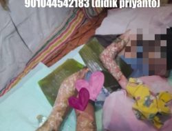 Warga DK Gading Kompak Galang Donasi untuk Biaya Bedah Plastik Akhtar, Pemkab Pati Diharapkan Turun Tangan